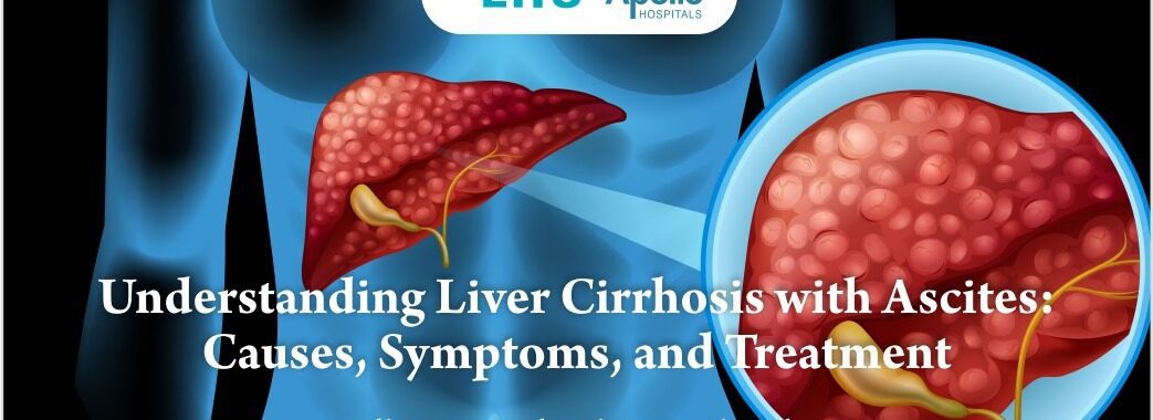 Liver Cirrhosis with Ascites: Causes, Symptoms, Treatment