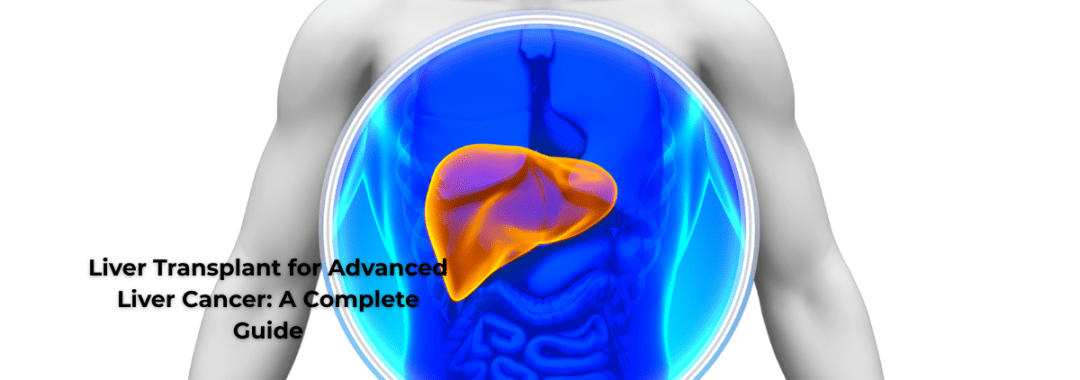 Liver Transplant for Advanced Liver Cancer A Complete Guide