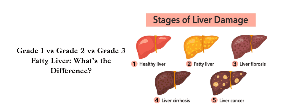 Grade 1 vs Grade 2 vs Grade 3 Fatty Liver What’s the Difference