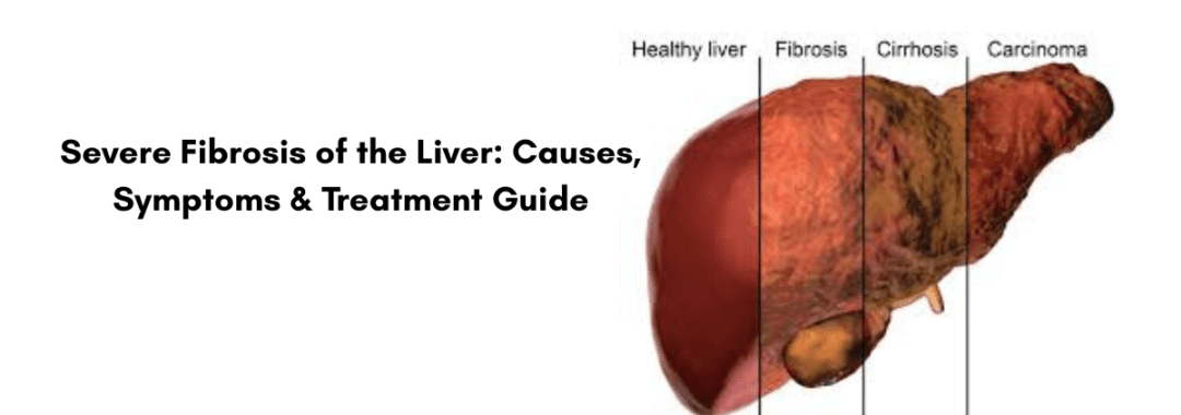 Severe Fibrosis of the Liver Causes, Symptoms & Treatment Guide (1)