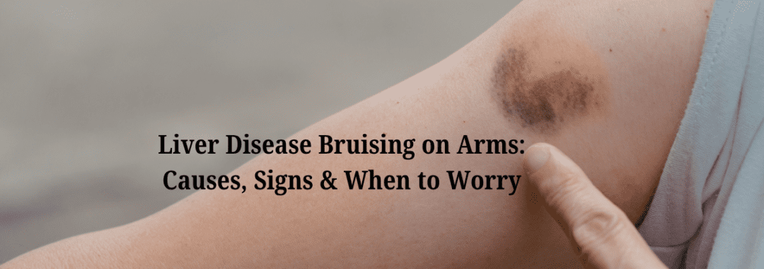 Liver Disease Bruising on Arms Causes, Signs & When to Worry