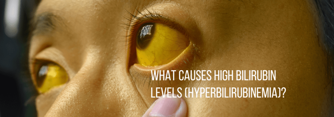 What Causes High Bilirubin Levels (Hyperbilirubinemia)? A Complete Guide