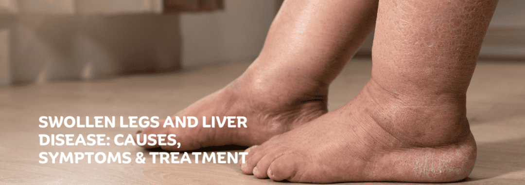 best liver transplant specialist in delhi