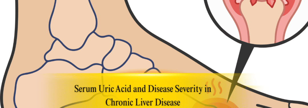 Serum Uric Acid and Disease Severity in Chronic Liver Disease